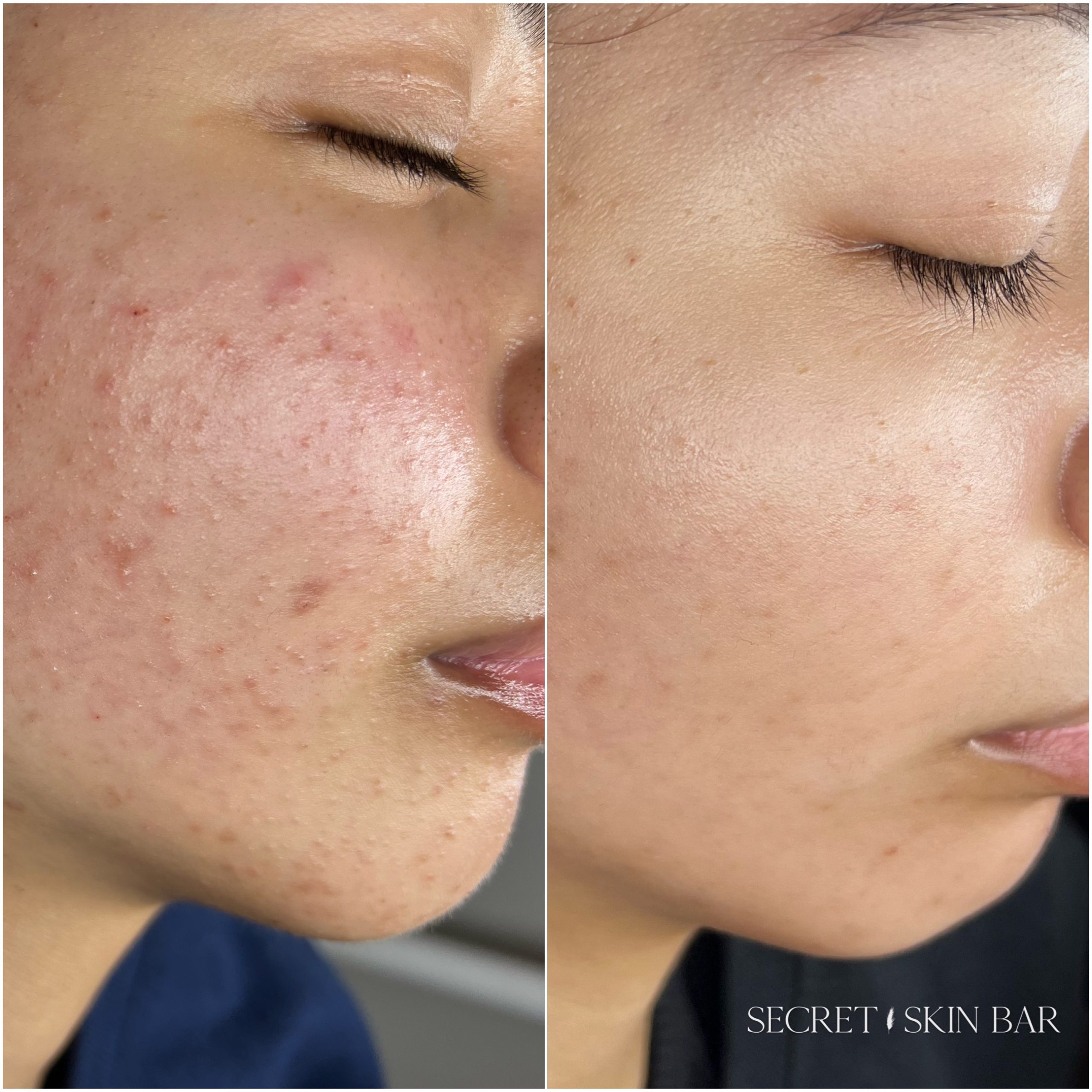 Client skin treatment photo 4