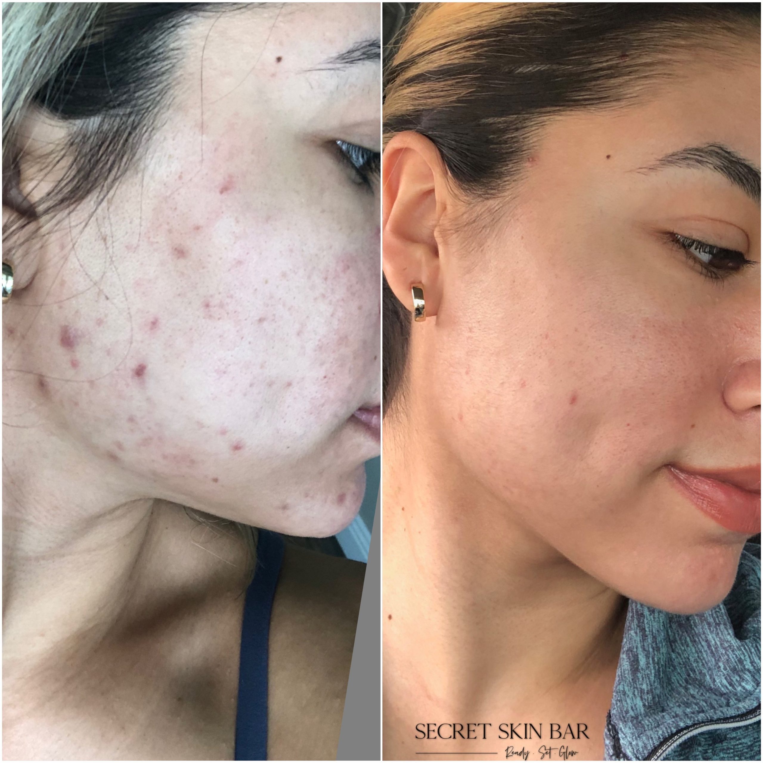 Client skin treatment photo 2