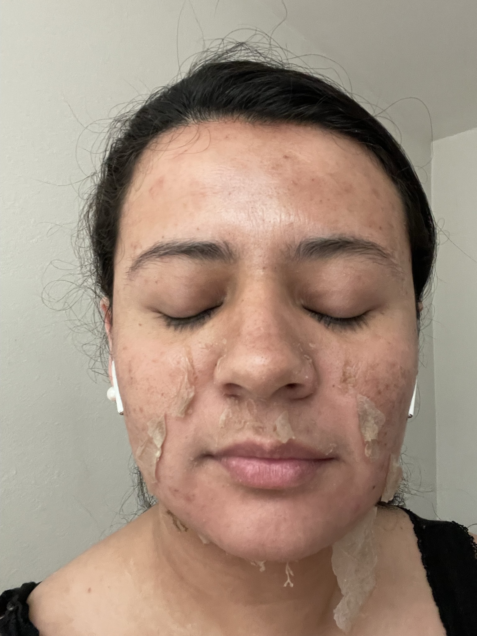 Client skin treatment photo 19