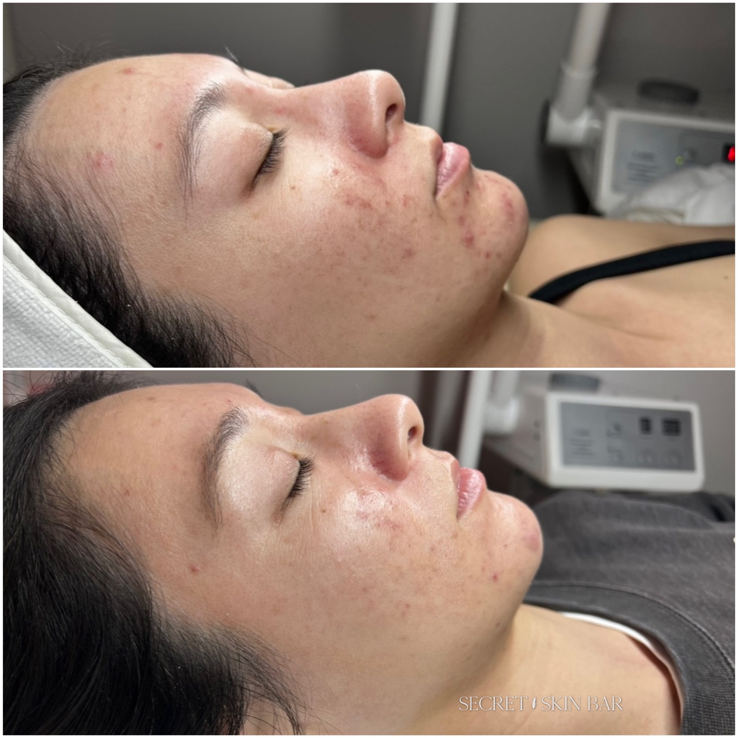 Client skin treatment photo 5